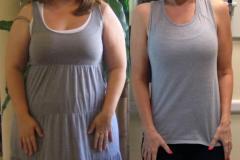 Bariatric Surgery - Before & After Weight Loss Surgery Photo - Gastric Band Sleeve Bypass Balloon