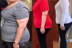 Bariatric Surgery - Before & After Weight Loss Surgery Photo - Gastric Band Sleeve Bypass Balloon