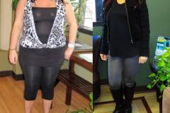 Bariatric Surgery - Before & After Weight Loss Surgery Photo - Gastric Band Sleeve Bypass Balloon