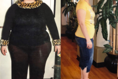 Bariatric Surgery - Before & After Weight Loss Surgery Photo - Gastric Band Sleeve Bypass Balloon