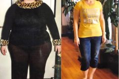 Bariatric Surgery - Before & After Weight Loss Surgery Photo - Gastric Band Sleeve Bypass Balloon