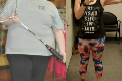 Bariatric Surgery - Before & After Weight Loss Surgery Photo - Gastric Band Sleeve Bypass Balloon