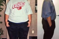 Bariatric Surgery - Before & After Weight Loss Surgery Photo - Gastric Band Sleeve Bypass Balloon