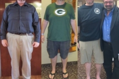 Bariatric Surgery - Before & After Weight Loss Surgery Photo - Gastric Band Sleeve Bypass Balloon
