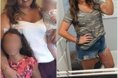 Bariatric Surgery - Before & After Weight Loss Surgery Photo - Gastric Band Sleeve Bypass Balloon