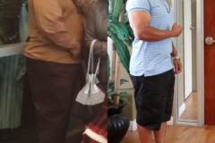 Bariatric Surgery - Before & After Weight Loss Surgery Photo - Gastric Band Sleeve Bypass Balloon