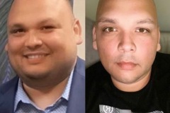 Bariatric Surgery - Before & After Weight Loss Surgery Photo - Gastric Band Sleeve Bypass Balloon
