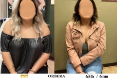 Bariatric Surgery - Before & After Weight Loss Surgery Photo - Gastric Band Sleeve Bypass Balloon