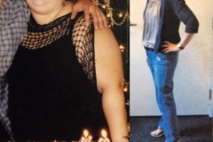 Bariatric Surgery - Before & After Weight Loss Surgery Photo - Gastric Band Sleeve Bypass Balloon