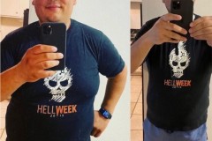 Bariatric Surgery - Before & After Weight Loss Surgery Photo - Gastric Band Sleeve Bypass Balloon