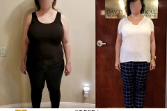 Bariatric Surgery - Before & After Weight Loss Surgery Photo - Gastric Band Sleeve Bypass Balloon