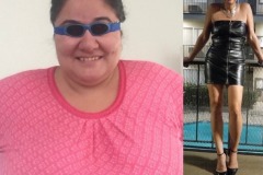 Bariatric Surgery - Before & After Weight Loss Surgery Photo - Gastric Band Sleeve Bypass Balloon