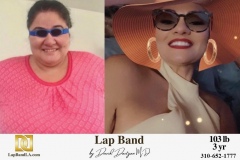 Bariatric Surgery - Before & After Weight Loss Surgery Photo - Gastric Band Sleeve Bypass Balloon