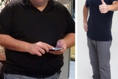 Bariatric Surgery - Before & After Weight Loss Surgery Photo - Gastric Band Sleeve Bypass Balloon