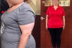 Bariatric Surgery - Before & After Weight Loss Surgery Photo - Gastric Band Sleeve Bypass Balloon
