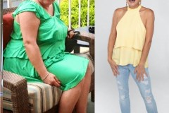 Bariatric Surgery - Before & After Weight Loss Surgery Photo - Gastric Band Sleeve Bypass Balloon