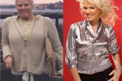Bariatric Surgery - Before & After Weight Loss Surgery Photo - Gastric Band Sleeve Bypass Balloon