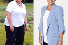 Bariatric Surgery - Before & After Weight Loss Surgery Photo - Gastric Band Sleeve Bypass Balloon