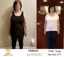 Bariatric Surgery - Before & After Weight Loss Surgery Photo - Gastric Band Sleeve Bypass Balloon