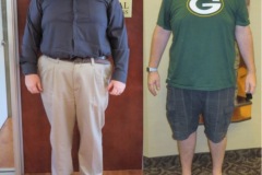 Bariatric Surgery - Before & After Weight Loss Surgery Photo - Gastric Band Sleeve Bypass Balloon