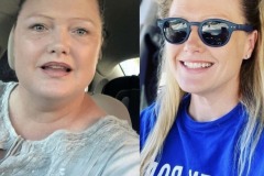 Bariatric Surgery - Before & After Weight Loss Surgery Photo - Gastric Band Sleeve Bypass Balloon
