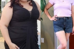 Bariatric Surgery - Before & After Weight Loss Surgery Photo - Gastric Band Sleeve Bypass Balloon