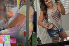 Bariatric Surgery - Before & After Weight Loss Surgery Photo - Gastric Band Sleeve Bypass Balloon