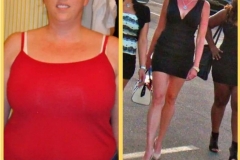 Bariatric Surgery - Before & After Weight Loss Surgery Photo - Gastric Band Sleeve Bypass Balloon