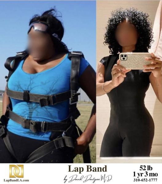 Bariatric Surgery - Before & After Weight Loss - Lap Band