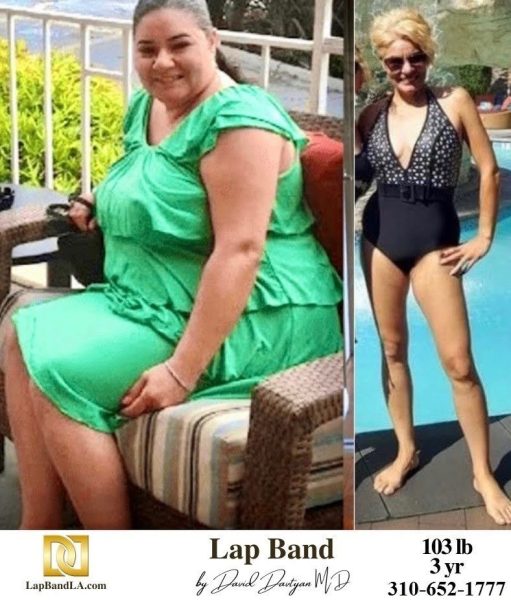 Bariatric Surgery - Before & After Weight Loss - Lap Band