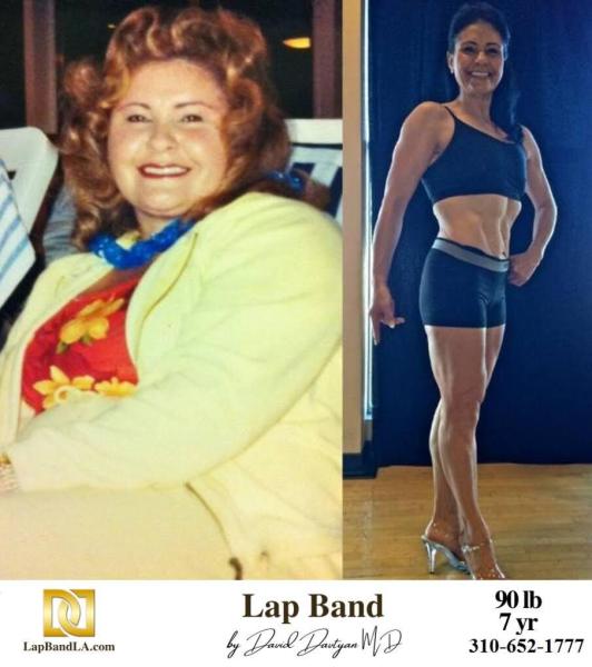 Bariatric Surgery - Before & After Weight Loss - Lap Band
