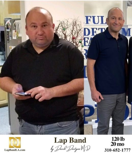 Bariatric Surgery - Before & After Weight Loss - Lap Band