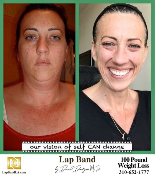 Bariatric Surgery - Before & After Weight Loss - Lap Band