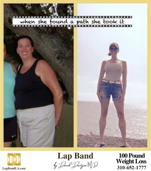 Bariatric Surgery - Before & After Weight Loss - Lap Band