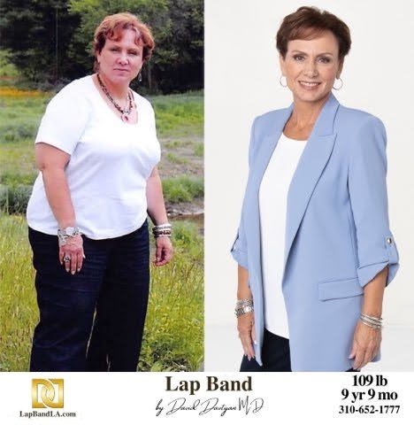 Bariatric-Surgery-Before-_-After-Weight-Loss-Lap-Band-Gastric-Sleeve-Gastric-Bypass-Gastric-Balloon-7
