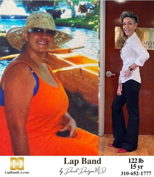 Bariatric Surgery - Before & After Weight Loss - Lap Band