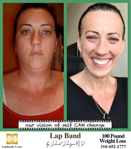 Bariatric Surgery - Before & After Weight Loss - Lap Band