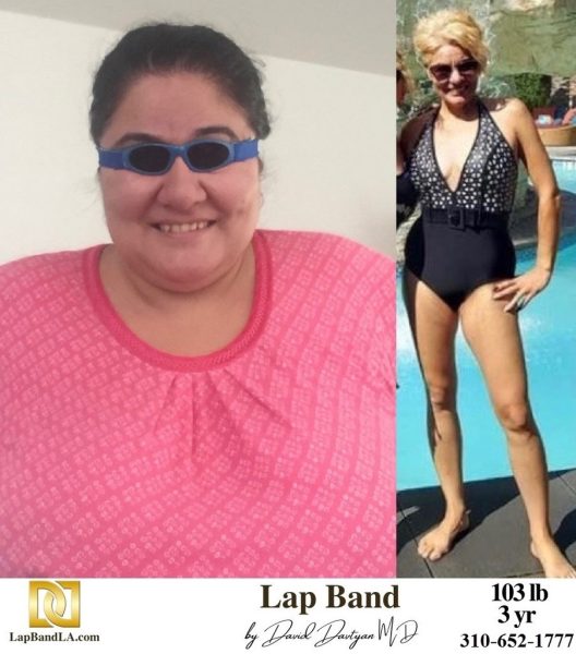 Bariatric Surgery - Before & After Weight Loss - Lap Band