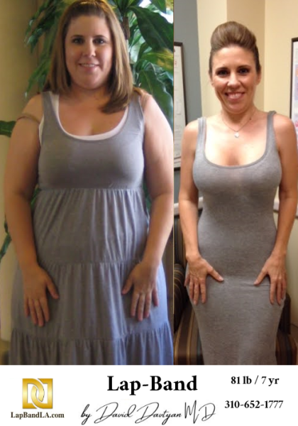 Before-and-after-weight-loss-surgery-patient-photo2