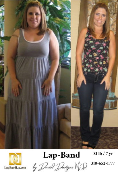 Before-and-after-weight-loss-surgery-patient-photo3