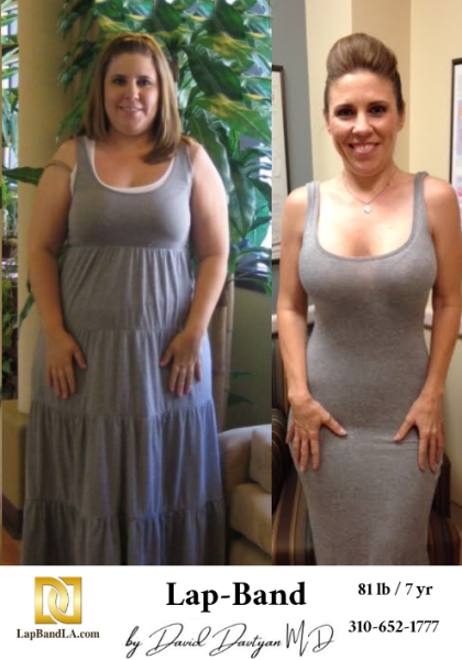 Before-and-after-weight-loss-surgery-patient-photo4