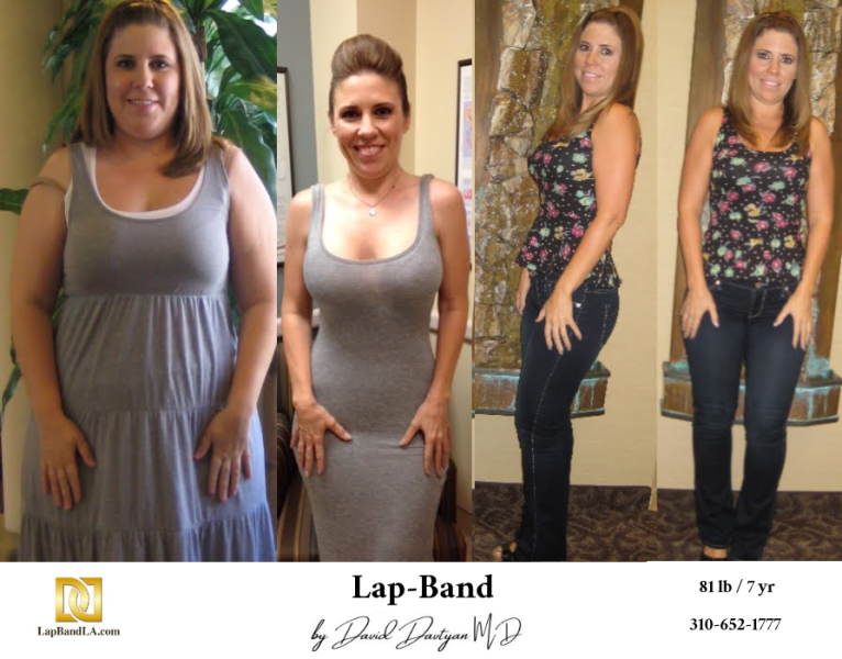 Before-and-after-weight-loss-surgery-patient-photo5