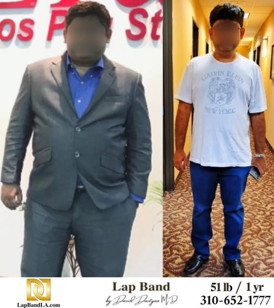LapBandLA.com