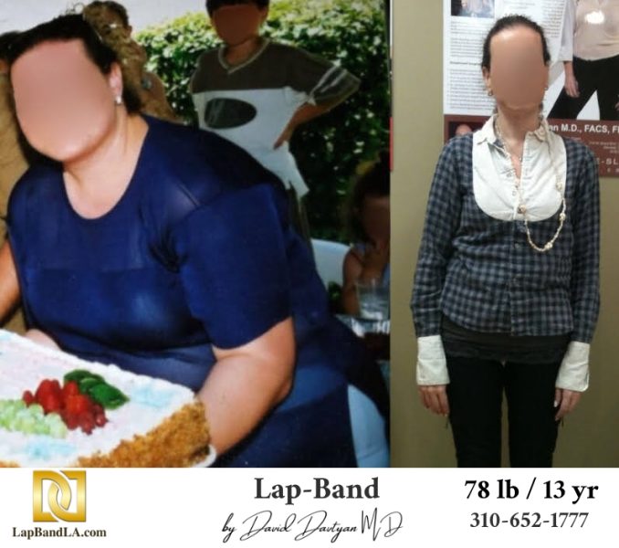 Lap-Band-Before-After-Bariatric-Surgery-Photo-1-43