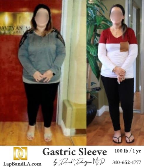 Lap-Band-Before-After-Bariatric-Surgery-Photo-1-46