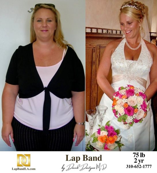 LapBandLA.com