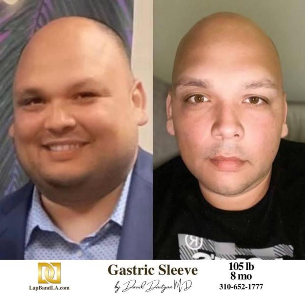 Bariatric Surgery - Before & After Weight Loss Surgery Photo - Gastric Band Sleeve Bypass Balloon
