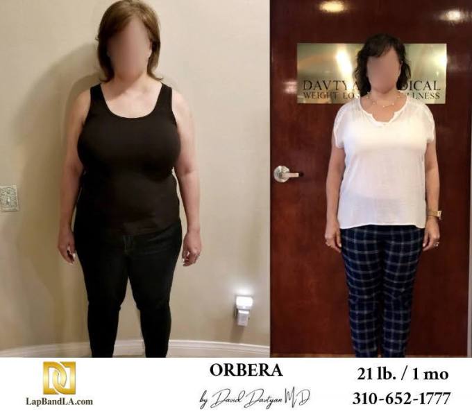 Bariatric Surgery - Before & After Weight Loss Surgery Photo - Gastric Band Sleeve Bypass Balloon