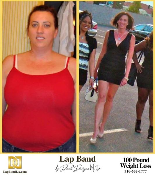 LapBandLA.com