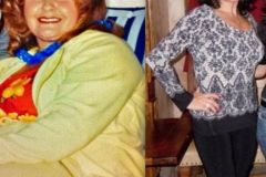 Bariatric Surgery - Before & After Weight Loss - Lap Band